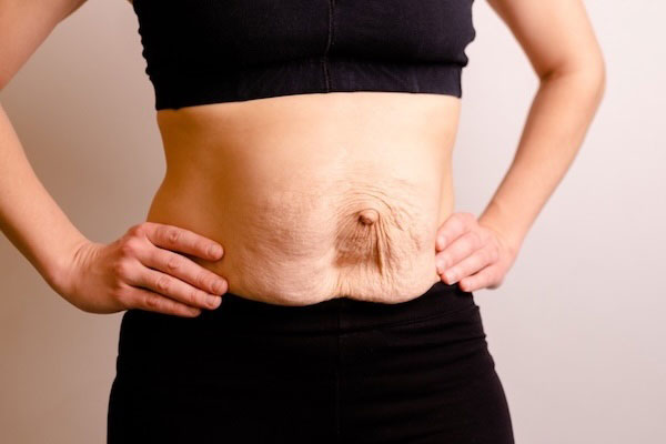 DIÀSTASI RECTES ABDOMINALS